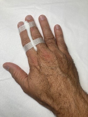 A hand with the index and middle fingers strapped together with gauze between them