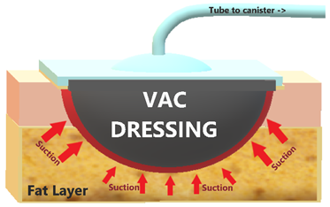 An image demonstrating how the suction (negative pressure) encourages the wound to heal quicker