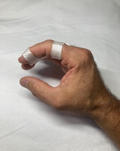 A hand with the index and middle fingers strapped together with gauze between them